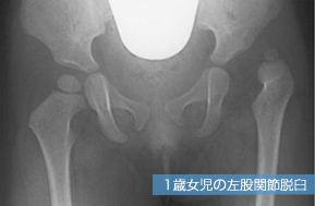 http://www.u-tokyo-ortho.jp/outpatient/disease/images/ex_di_ch01_img_01.jpg