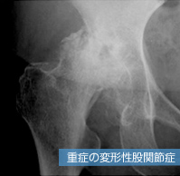 重症の変形性股関節症