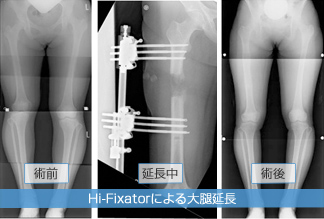 Hi-Fixatorによる大腿延長