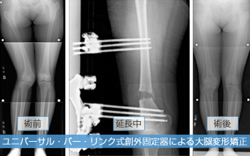 ユニバーサル・バー・リンク式創外固定器による大腿変形矯正