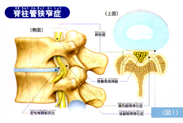 腰部脊柱管狭窄症 図1