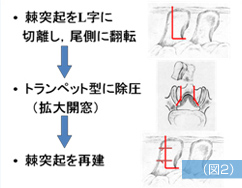 腰部脊柱管狭窄症 図2